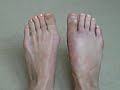 bunion surgery scar bunion surgery scar