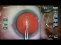 Mastel Illuminating Surgical Keratoscope