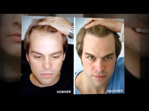 Haarausfall stoppen - natürlich, ohne Medikamente, wir helfen!