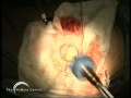 Birmingham Hip Resurfacing (BHR) by Derek McMinn Part 4