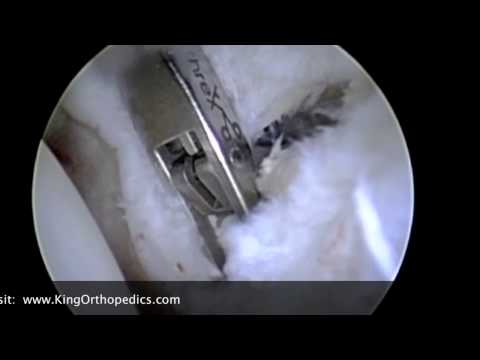 how to locate psoas