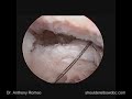 Arthroscopic Subscapularis Repair with Anthony A. Romeo, M.D., Part 3 Arthroscopic Subscapularis Repair with Anthony A. Romeo, M.D., Part 3
