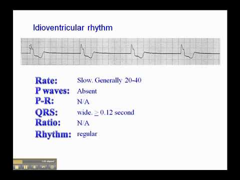 how to treat idioventricular rhythm