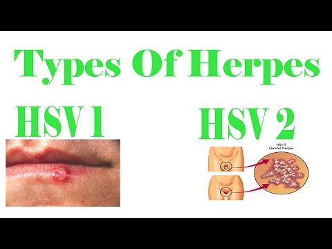 how to cure hsv 1