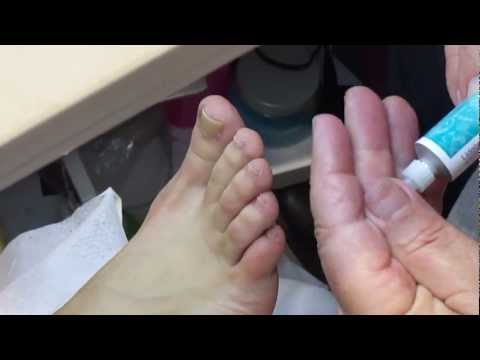 how to treat ingrown toenail