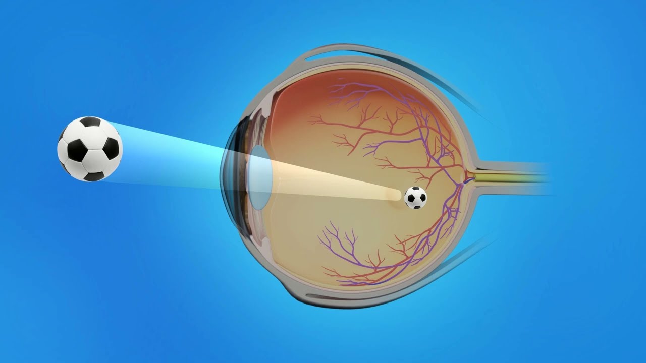 Glaucoma Overview