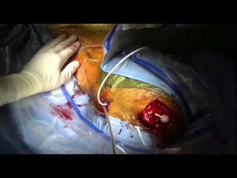 how to treat a blocked vp shunt