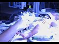 Mark under bilirubin lights with foam eye covering Bilirubin