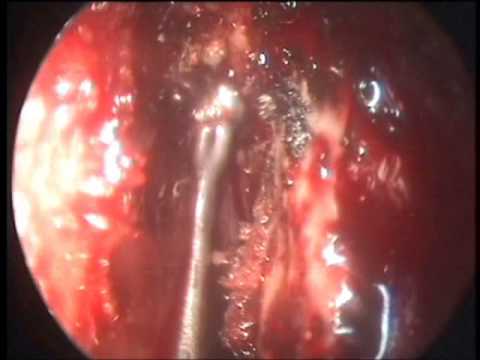 how to identify csf leak