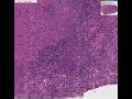 Histopathology Lymph node --Metastatic undifferentiated larg