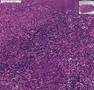 Histopathology Lymph node --Metastatic undifferentiated larg