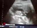14 week ultrasound