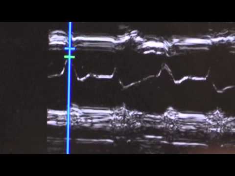 how to treat lv dysfunction