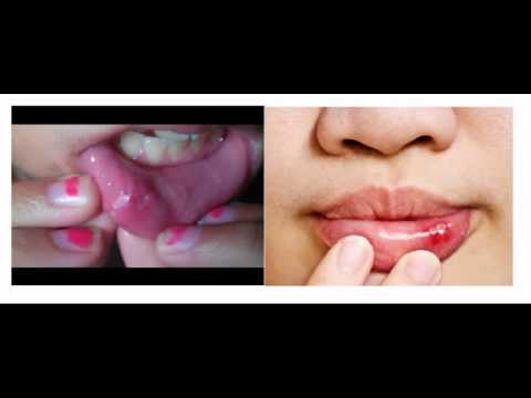 how to cure canker sores fast