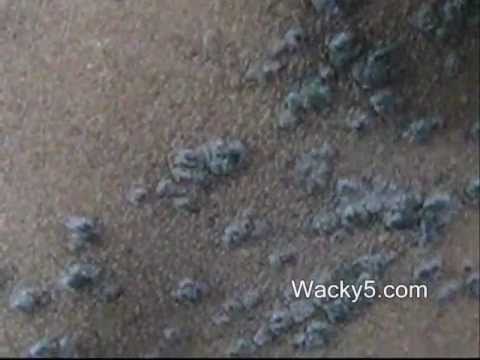 how to cure lichen planus