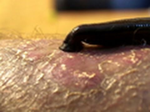 Leeches Cure | National Geographic