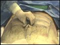In this video watch as doctors from  The Aesthetic Center for Plastic Surgery in Houston, TX transform a man's abdominal to create a six-pack by performing Abdominal Etching: Liposculpturing the Athletic Abdomen.Surgery preformed by Dr.German Newall and Dr.Henry A. Mentz. Technique first introduced and developed by Dr. Henry A. Mentz.For more information please visit: http://www.newallmd.com