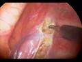 ETS Surgery (Endoscopic Thoracic Sympathectomy)