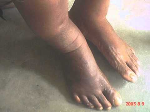 how to treat wuchereria bancrofti
