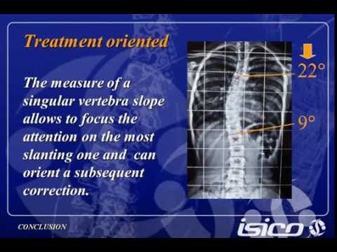 how to measure cervical curve on x-ray