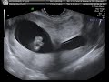 Baby McDee 2