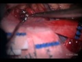 Clipping Of the Giant Aneurysm Of The Posterior Communicating Artery - Part 1 Clipping Of the Giant Aneurysm Of The Posterior Communicating Artery - Part 1