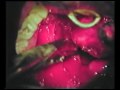cyst on tonsil requires tonsillectomy tonsillectomy