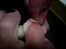 toe nail falling off