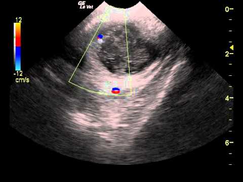 how to drain appendix abscess