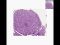 Histopathology Lymph node --Follicular lymphoma, grade 2