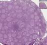 Histopathology Lymph node --Follicular lymphoma, grade 2