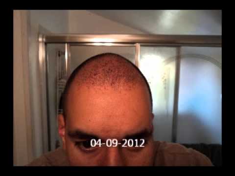 how to do hair transplant at home