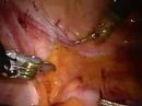 Podcast: Robotic-Assisted Prostatectomy - Reduces Risk of...