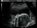 Baby Burton #3 ultrasound 20 week appointment