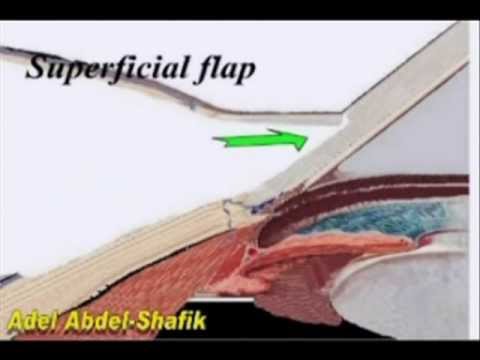 Non Pentrating Glaucoma Surgery : technique and difficulties.