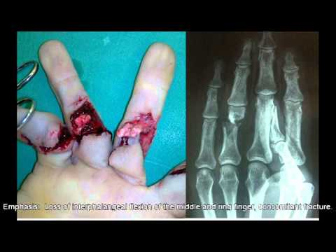 how to repair nerve damage in hand