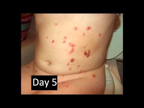 how to treat molluscum contagiosum