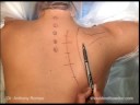 Scapulothoracic Fusion for Fascoscapulohumeral Muscular Dystrophy, Part 1 Scapulothoracic Fusion for Fascoscapulohumeral Muscular Dystrophy, Part 1