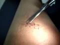 removing stitches