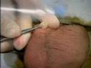 Vasectomy without A Scalpel: Remarkable! (Dramatic Health) Vasectomy