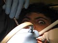 Getting Cavity FIlled
