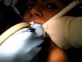 Getting Cavity FIlled