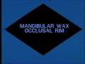 Mandibular Wax Occlusal Rim