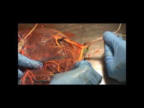 mauricecaspers - injection of monochorionic placenta with color dye.