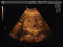 Luckitas (33 semanas)