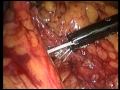 Multipe Polypes And Subtotal Excision Of The Colon