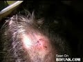 How To Remove botfly