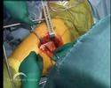 Birmingham Mid Head Resection (BMHR) Dysplasia Part 2