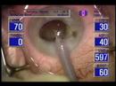 catarata-ifis-sindrome-iris-flacido-intraoperatorio.html