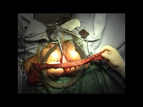 Altemeier Procedure for Complete Rectal Prolapse